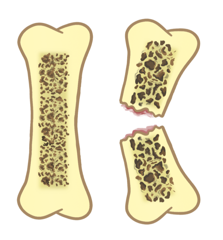 остеопороз